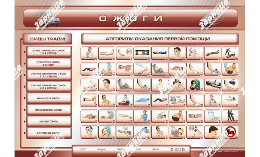 Перелом стенды